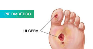 Pie diabético
