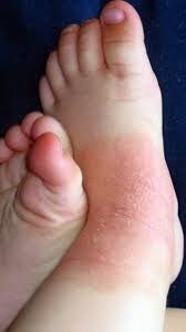 Patologías dermatológicas del pie